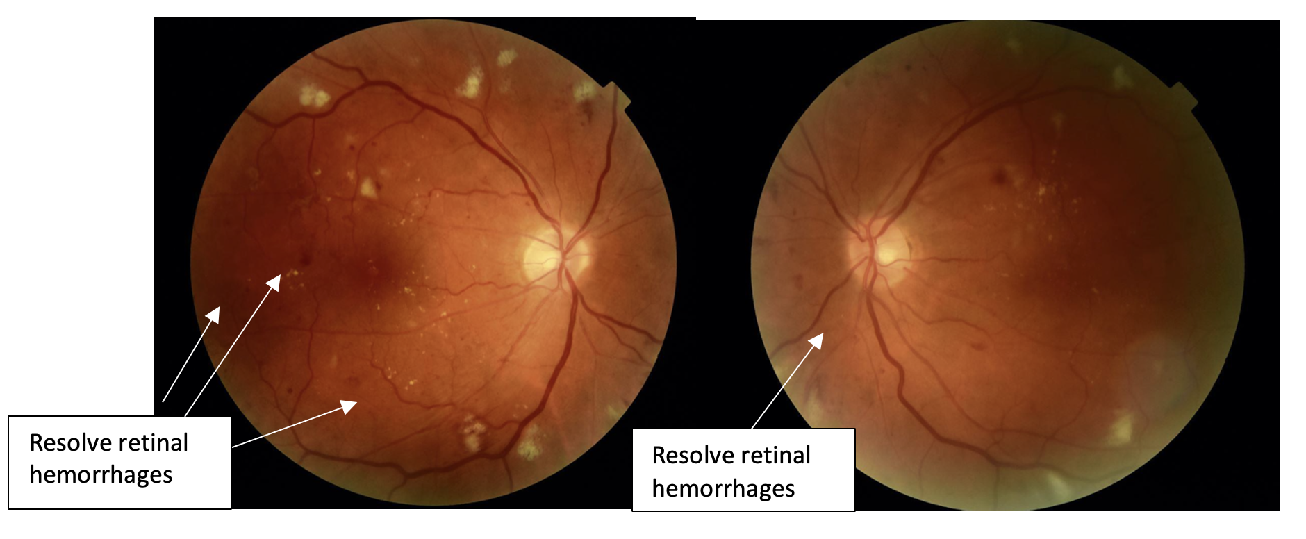 After diabetic retinopathy