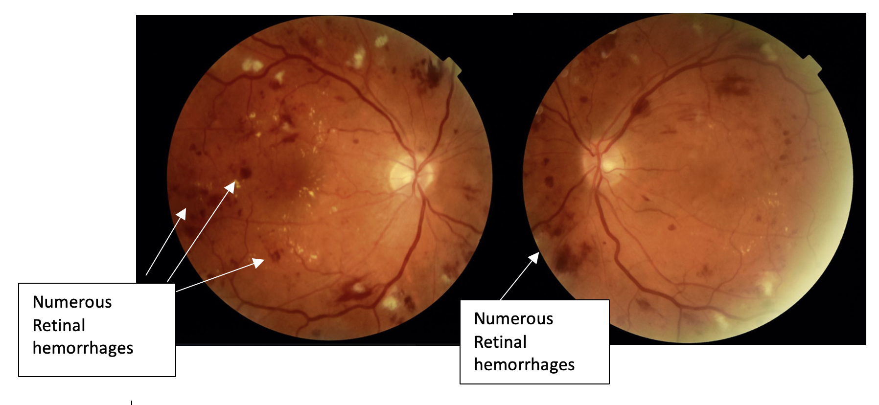Before diabetic retinopathy